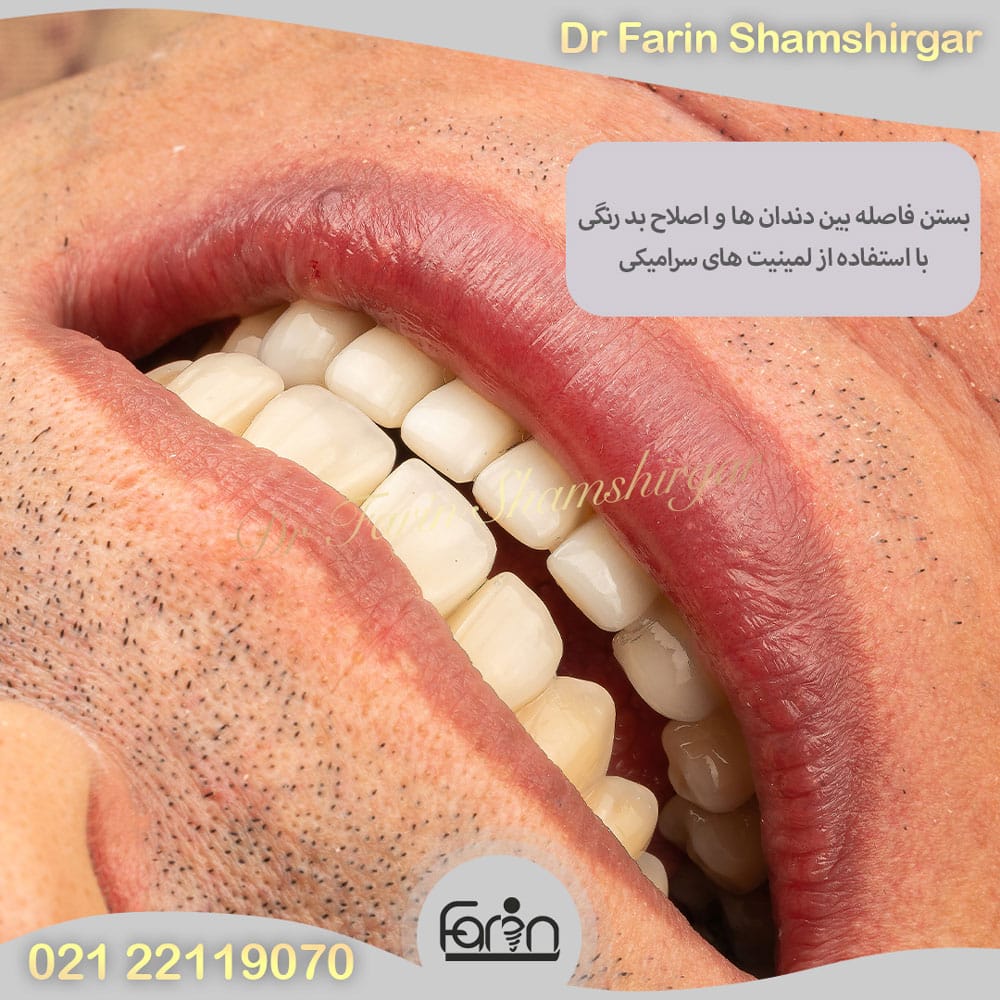 بهترین متخصص پروتز دندان در زعفرانیه