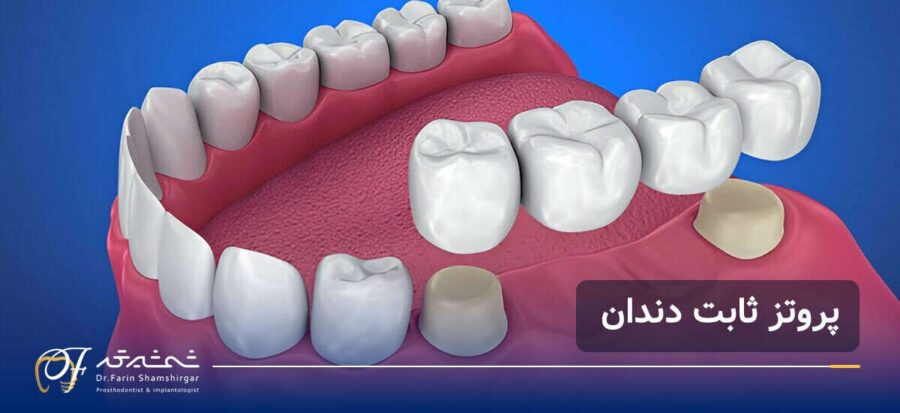 بهترین متخصص پروتز دندان در زعفرانیه