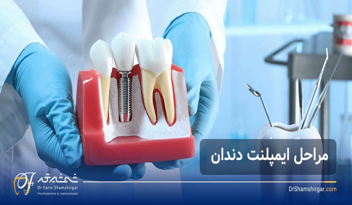 مراحل ایمپلنت دندان