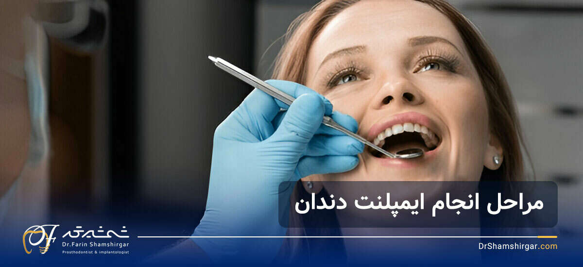 مراحل ایمپلنت دندان
