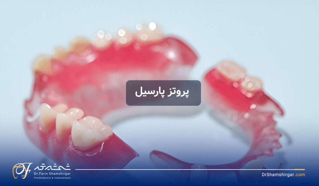 انواع پروتز دندان