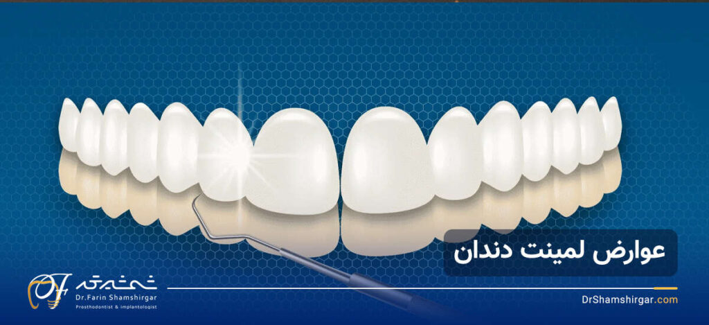 مزایا و معایب لمینت دندان