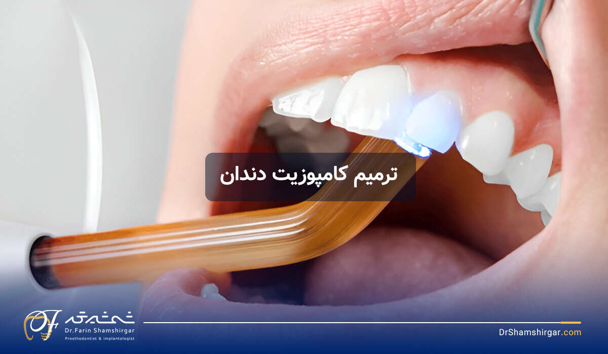 کامپوزیت دندان