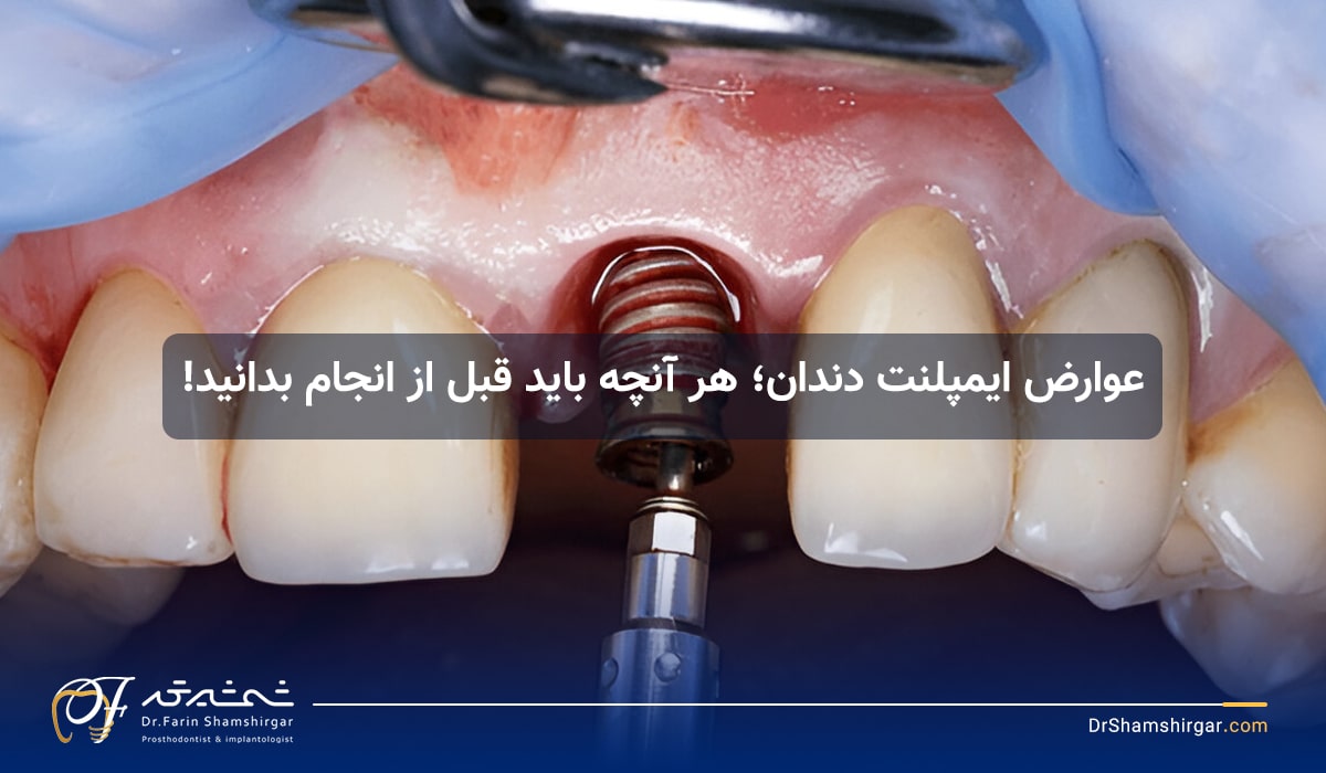 عوارض ایمپلنت دندان
