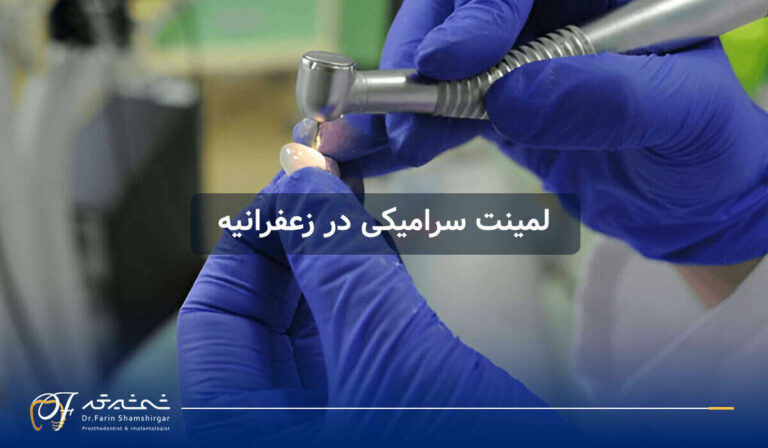 انواع لمینت دندان