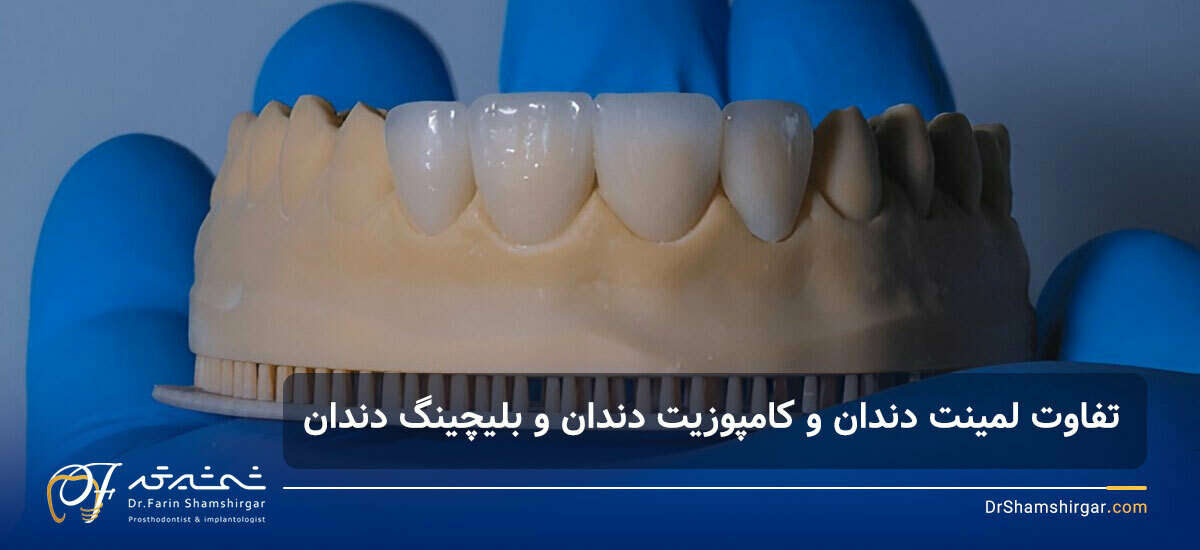 تفاوت لمینت دندان و کامپوزیت دندان
