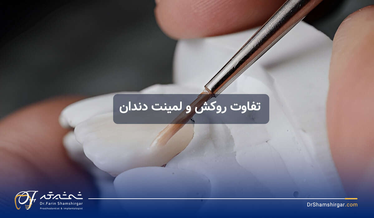 تفاوت لمینت دندان و روکش دندان