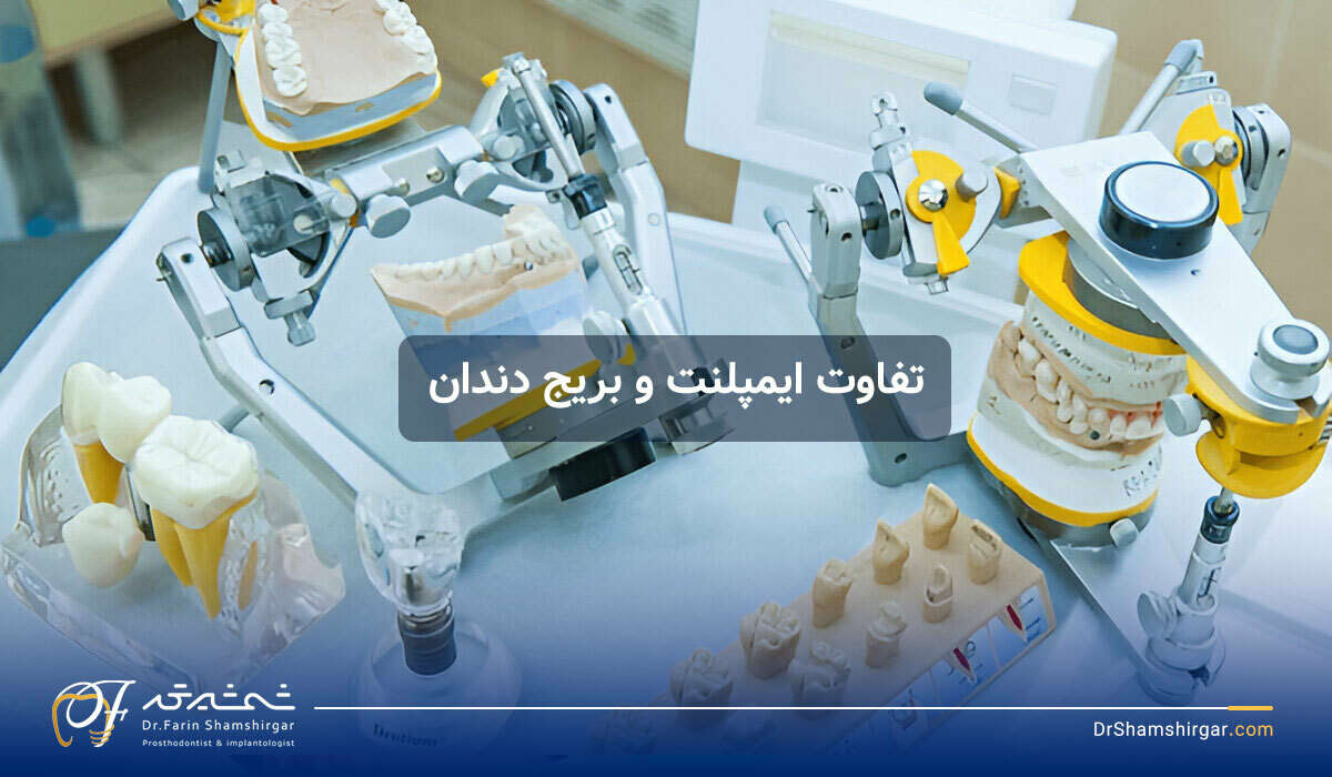 تفاوت ایمپلنت دندان و بریج دندان