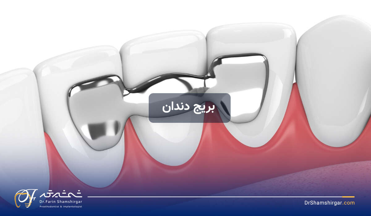 بریج دندان یا پل دندان