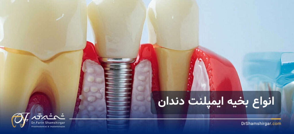 بخیه ایمپلنت دندان