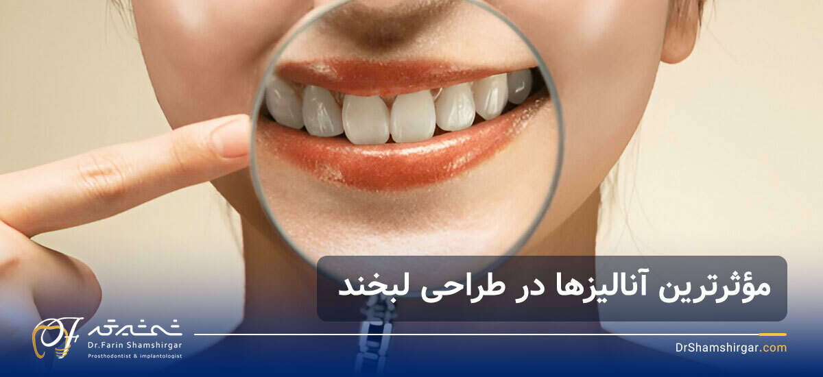 آنالیز طرح لبخند