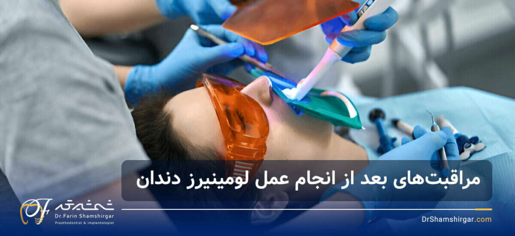 لومینیرز دندان