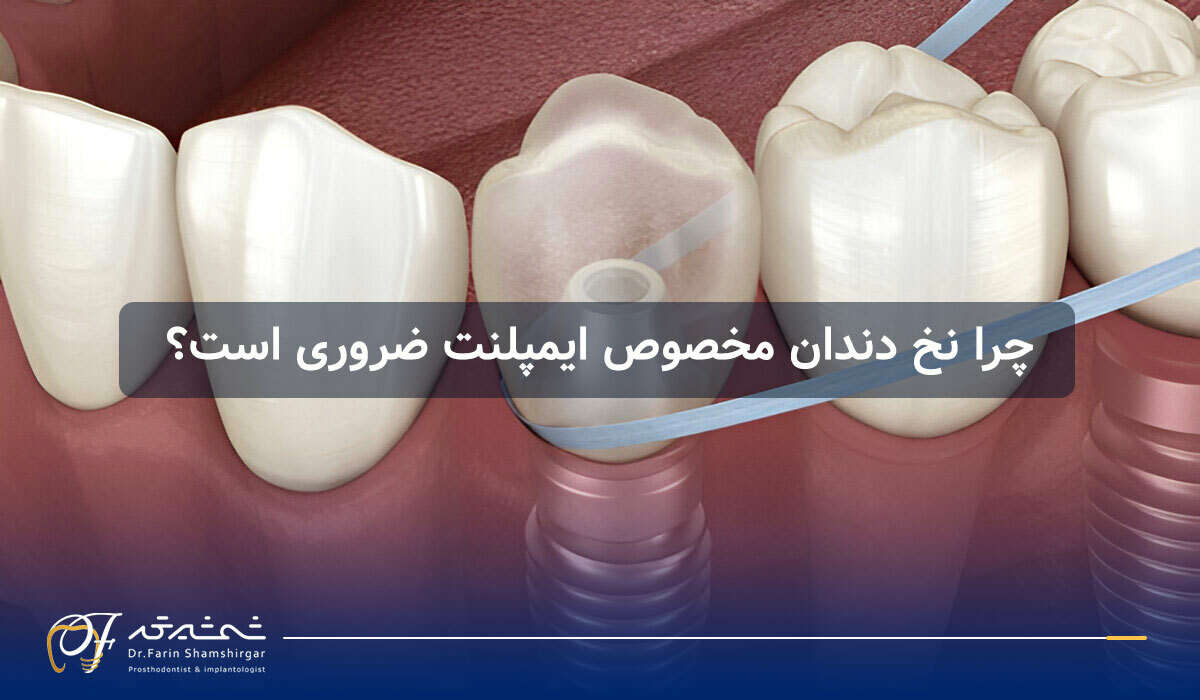 نخ دندان مخصوص ایمپلنت