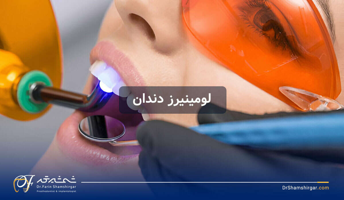 لومینیرز دندان