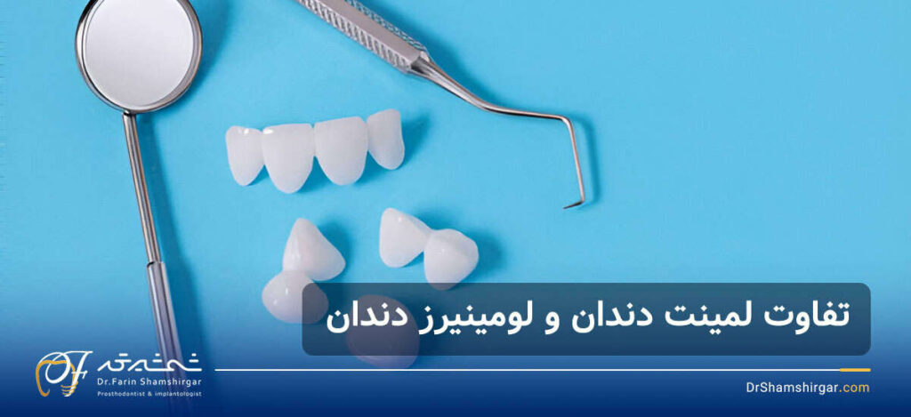 لومینیرز دندان