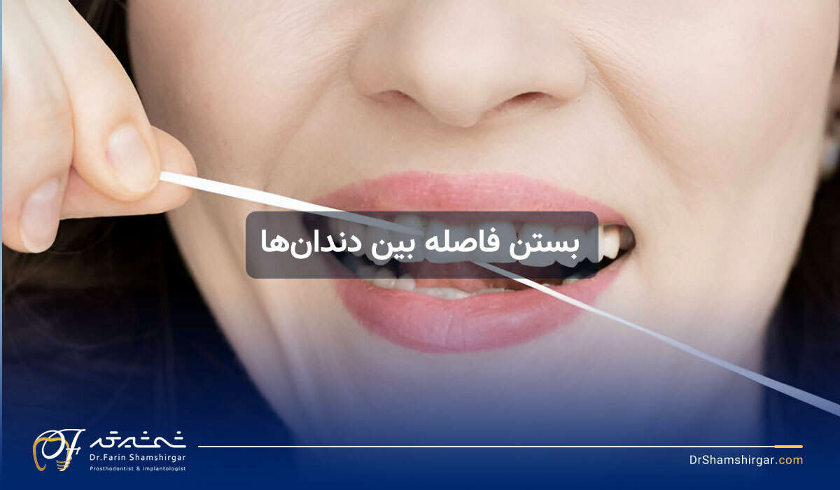 بستن فاصله بین دندان ها