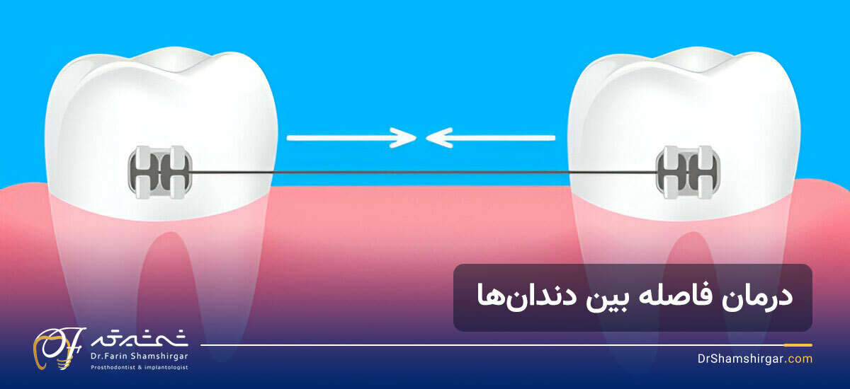 بستن فاصله بین دندان ها