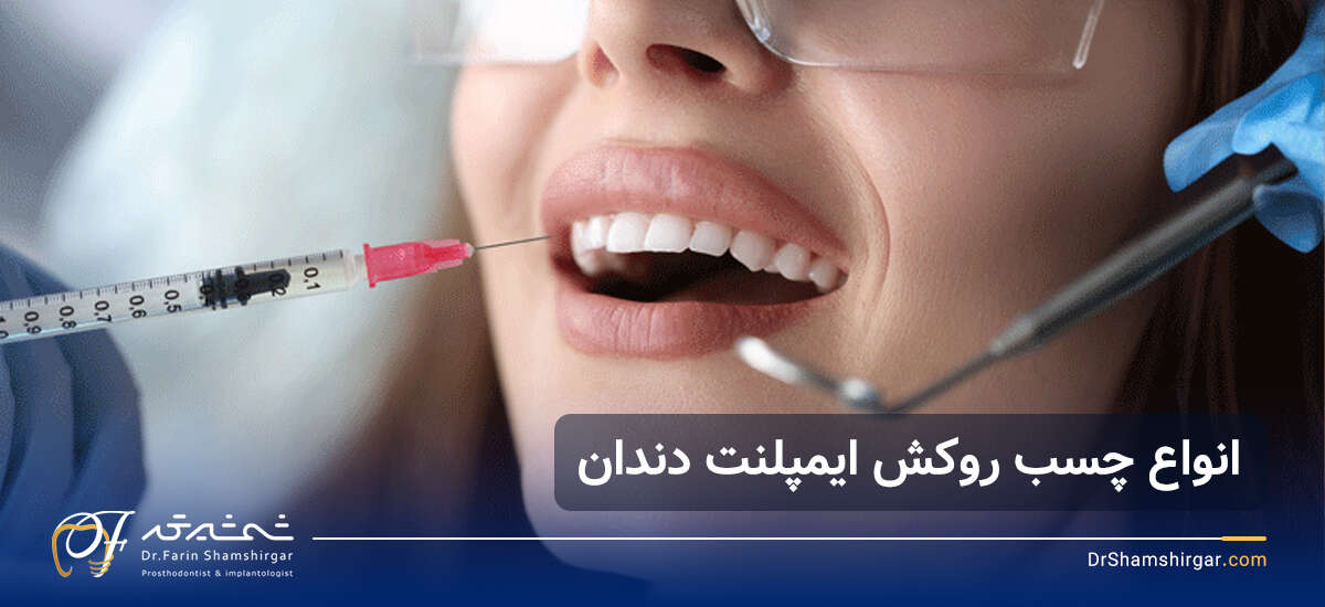 چسب ایمپلنت دندان