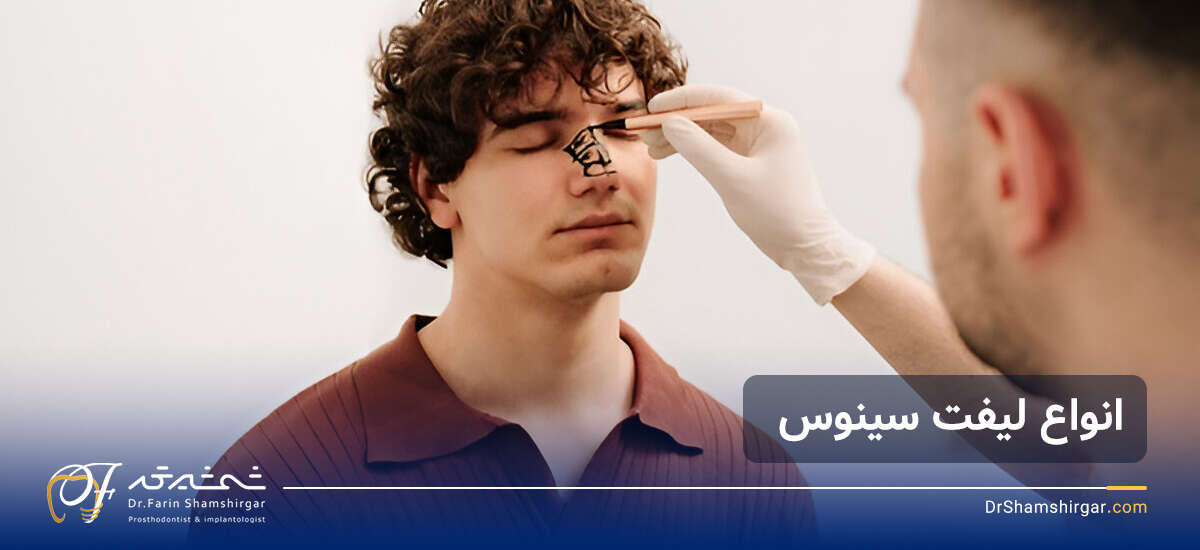 سینوس لیفت