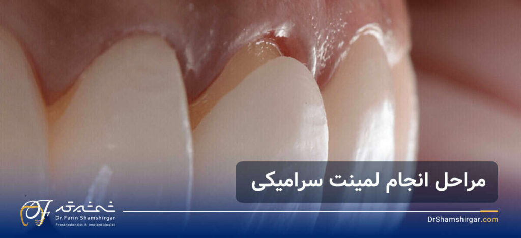 بهترین متخصص لمینت دندان در زعفرانیه