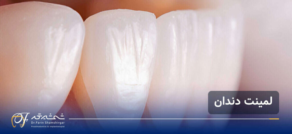 متخصص لمینت دندان در زعفرانیه