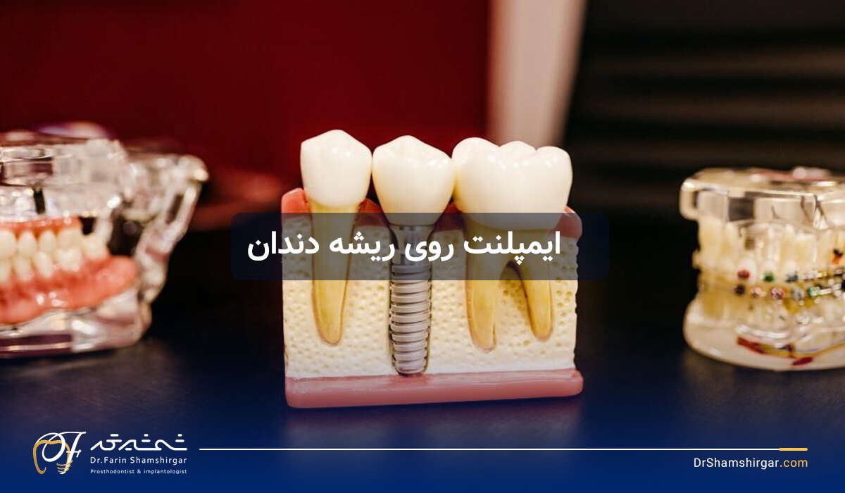 ایمپلنت روی ریشه دندان