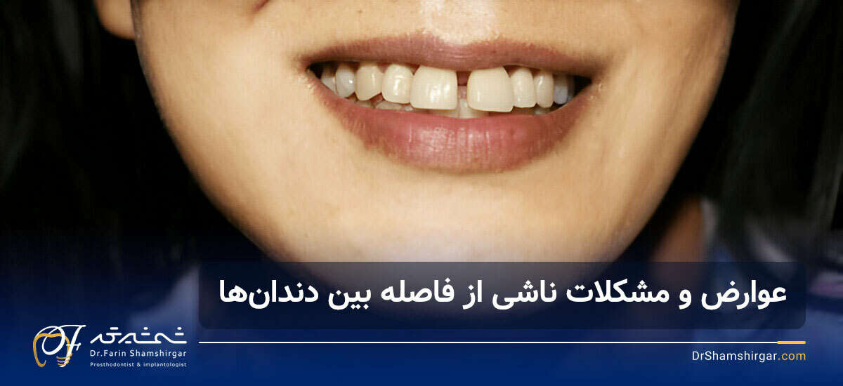 بستن فاصله بین دندان ها