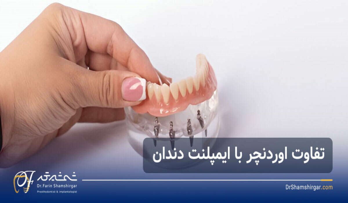 فرق اوردنچر با ایمپلنت دندان