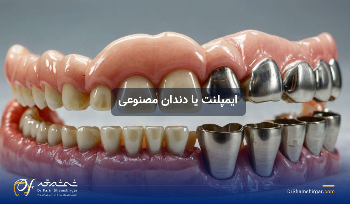 ایمپلنت دندان یا دندان مصنوعی چسبی