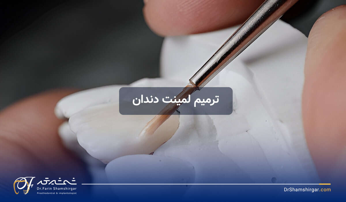 ترمیم لمینت دندان