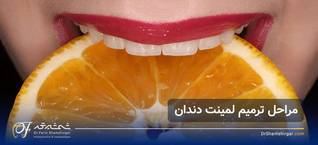 ترمیم لمینت دندان