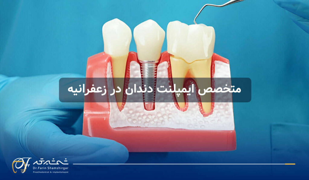 فرق اوردنچر با ایمپلنت دندان