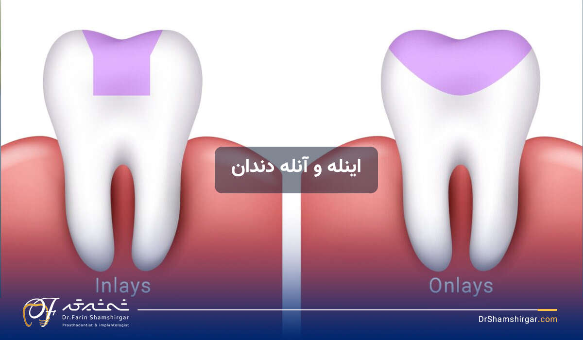 اینله و انله دندان