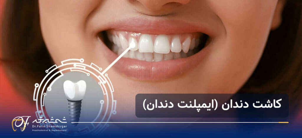 فرق اوردنچر با ایمپلنت دندان