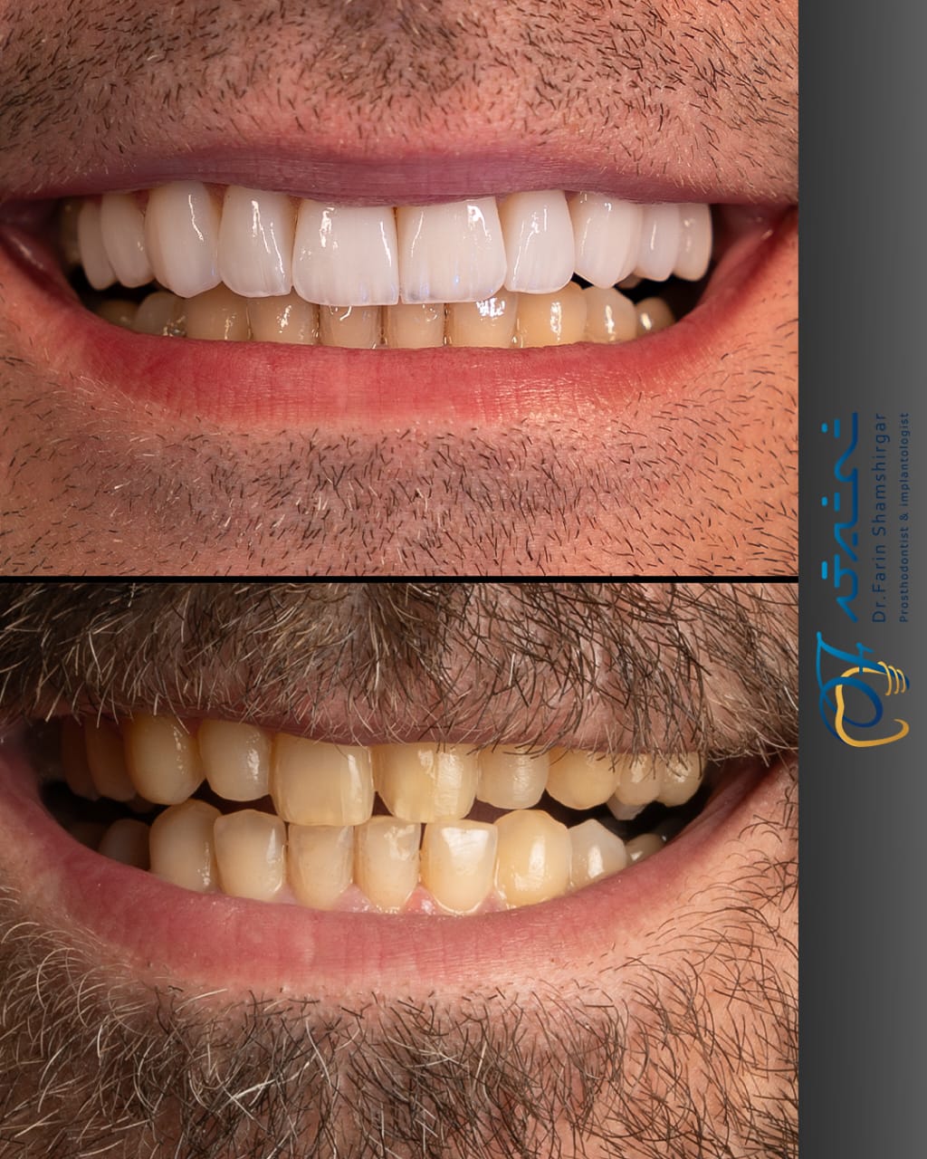 لمینت سرامیکی دندان